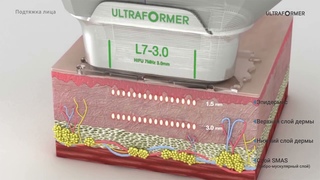 SMAS лифтинг Ultraformer