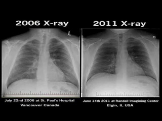 Chest X-Ray Electronic Cigarettes Before and After Smoking Health harmful