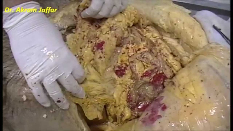 Where does abdominal fat accumulate (