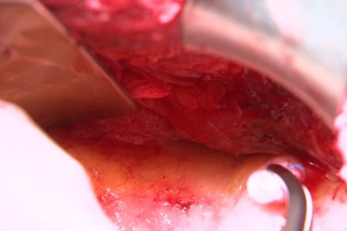 Posterior rectus sheath release (PRSP)